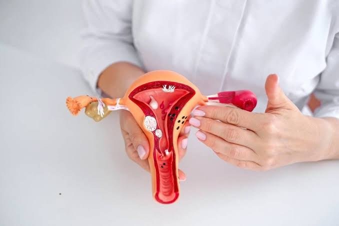 Endometriosis